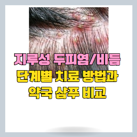 지루성피부염(두피염) 일반의약품 샴푸 선택 방법과 치료 단계 (가격 포함)