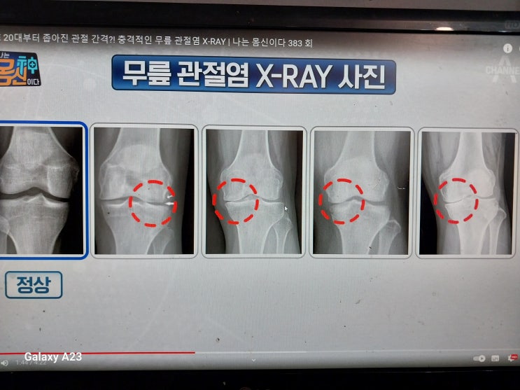  무릎관절염 치료 후기