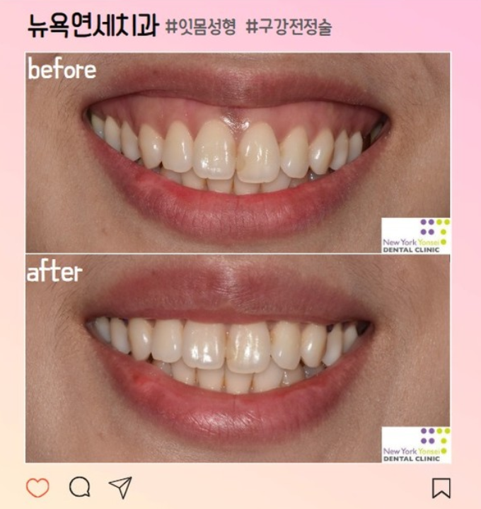  강남역 잇몸성형 | 웃을 때 많이 보이는 잇몸, 구강전정술 후기로 알아보는 거미스마일 교정