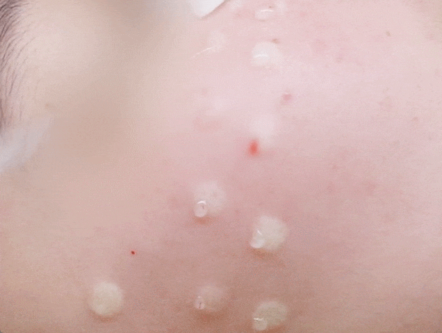 부산 스킨보톡스 피부과 전문의가 권유하지 않는 이유 부산 스킨보톡스 피부과 전문의가 권유하지 않는 이유