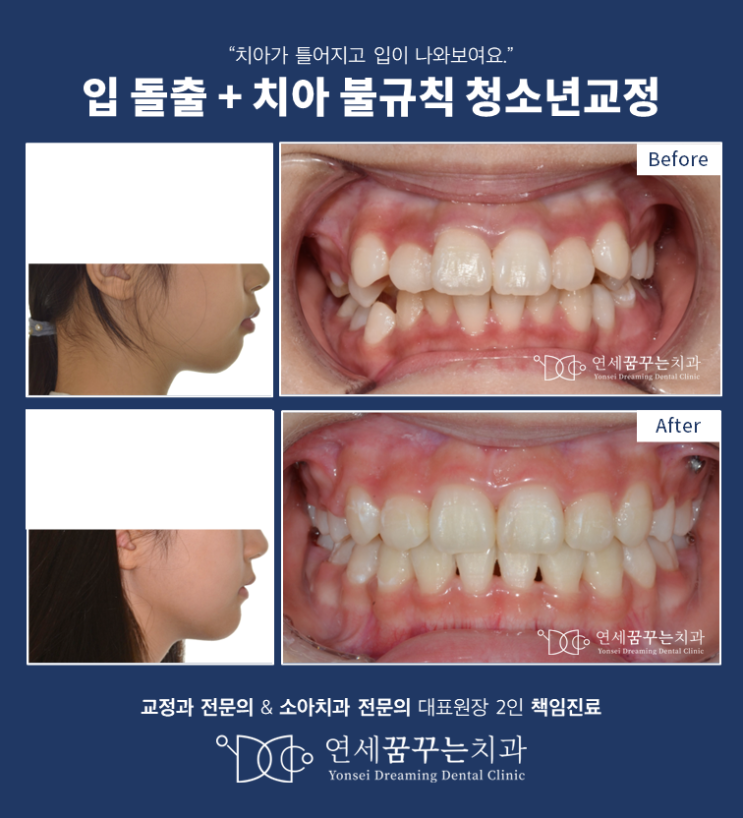 치아가 틀어져 보이고 입이 나온 경우? 청소년 교정치료 효과 치아가 틀어져 보이고 입이 나온 경우? 청소년 교정치료 효과
