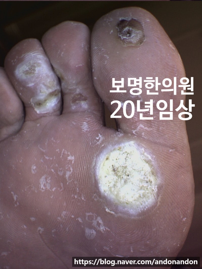 발바닥 사마귀에 초기 티눈 냉동치료 제거했다가 아기가 재발되어 낭패본 후기.