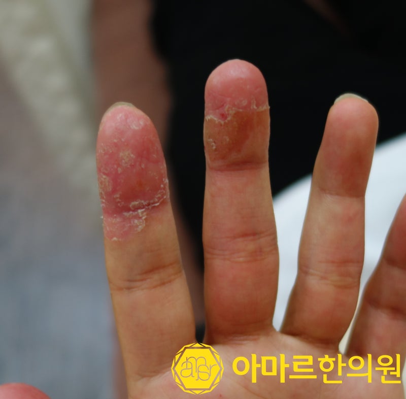 손가락 사이에 생긴 가려운 물집이 쉽게 사라지지 않는 이유