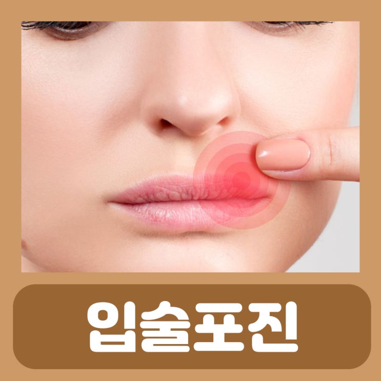 얼굴 단순포진 헤르페스 1형 입술포진 단순포진 물집 원인 증상 치료 약