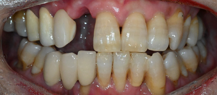 단대오거리 치과, 앞니 임플란트로 기능과 심미를 동시에 회복하는 방법!