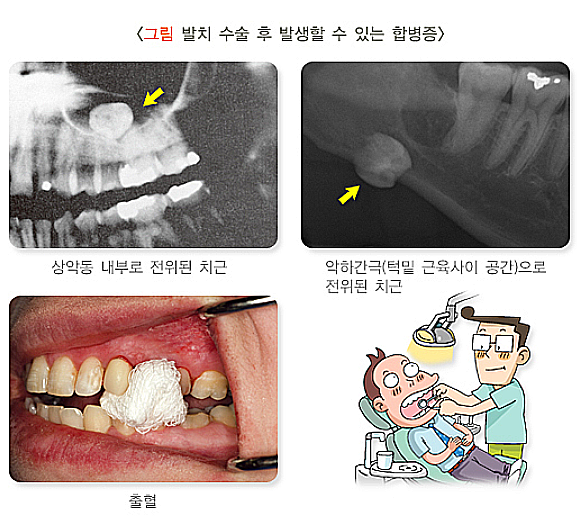 발치 과정, 발치 수술이 필요한 경우와 안되는 경우 자세히 알아보기 : 네이버 블로그