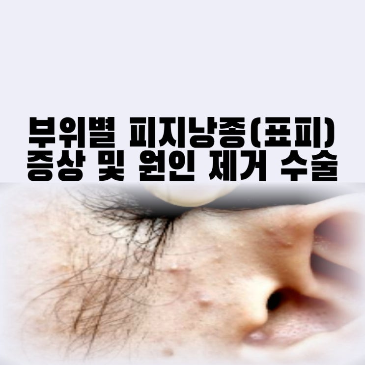  귀 피지낭종 표피낭종 원인 및 증상 겨드랑이 사타구니 귓볼 피지낭종 제거 수술 치료
