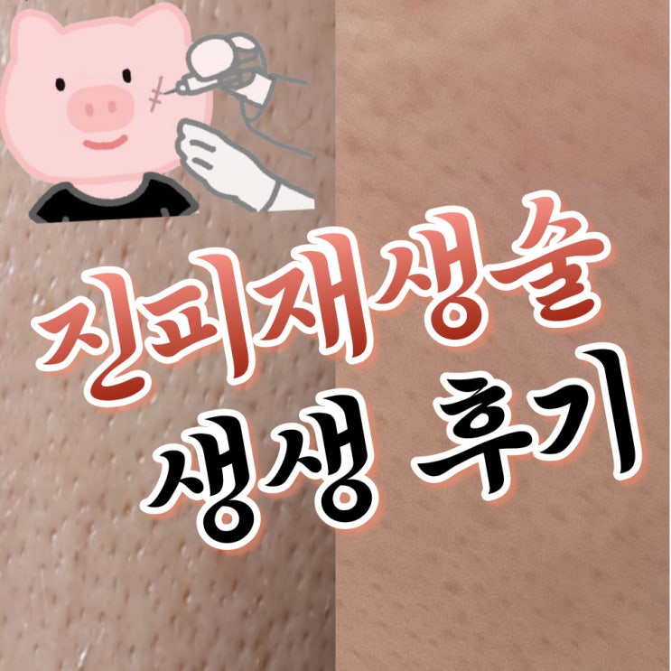  도안동 피부관리 블랑드지니 남자 진피재생술 후기(비용, 효과, 주의사항)