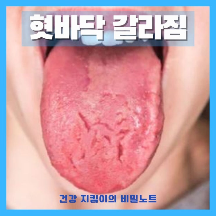 혓바닥 갈라짐 혀 갈라짐 원인 건강상태