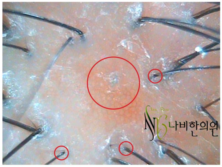  서면 정수리 탈모 빠른 해결법은