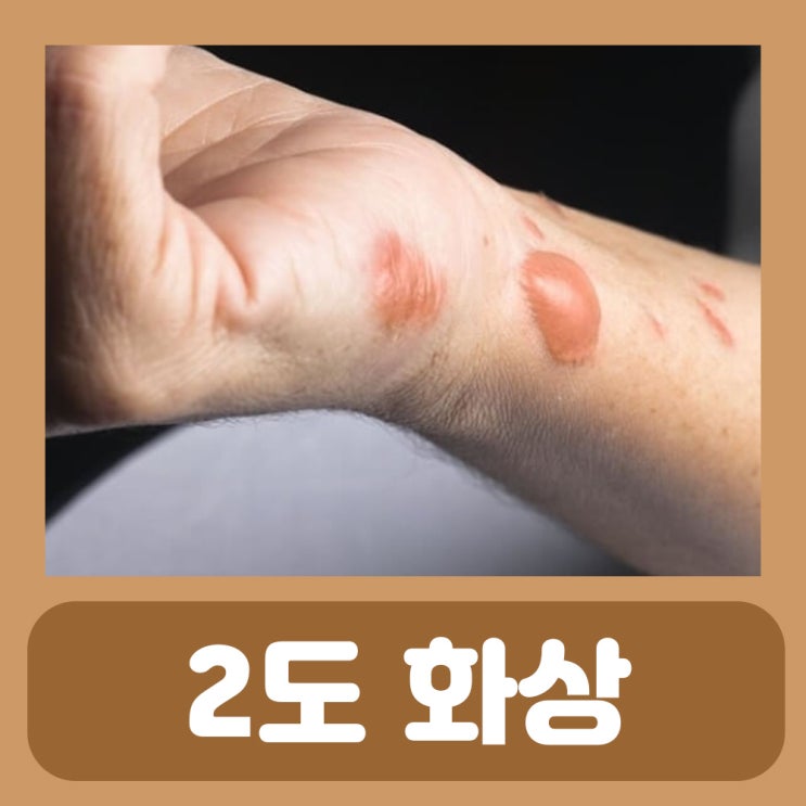  2도 화상 흉터 연고 물집 치료 응급처치