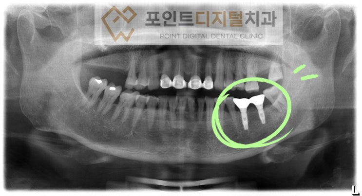  [탕정치과] 임플란트 19년 경과(3i 임플란트) / 천안 아산