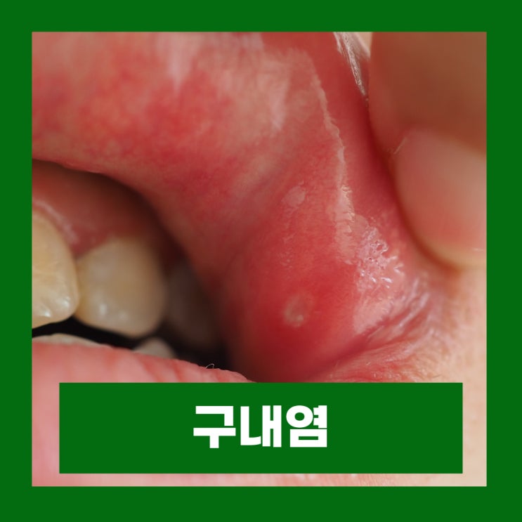  구내염 빨리 낫는법 알보칠 사용법