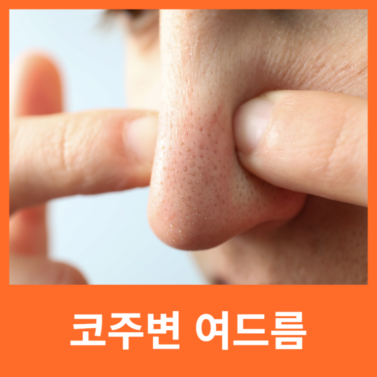  코주변여드름, 피부과 가기전 셀프 체크하기!