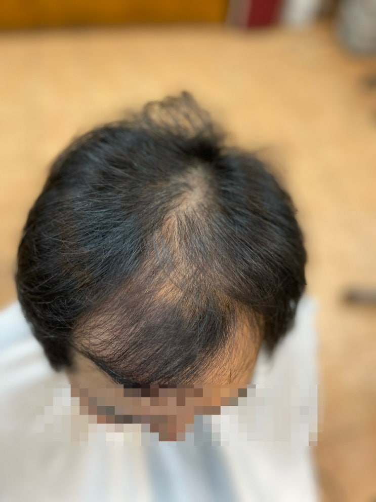  해운대구에서 왔어요 남자탈모성형펌 세젤부탈모펌/부산사상르네시떼헤어 주례감전학장김해당감부전진구전포부전양정범일범천수영망미안락동래미남충렬가야수영대연반송금정장전초량남포감만영도