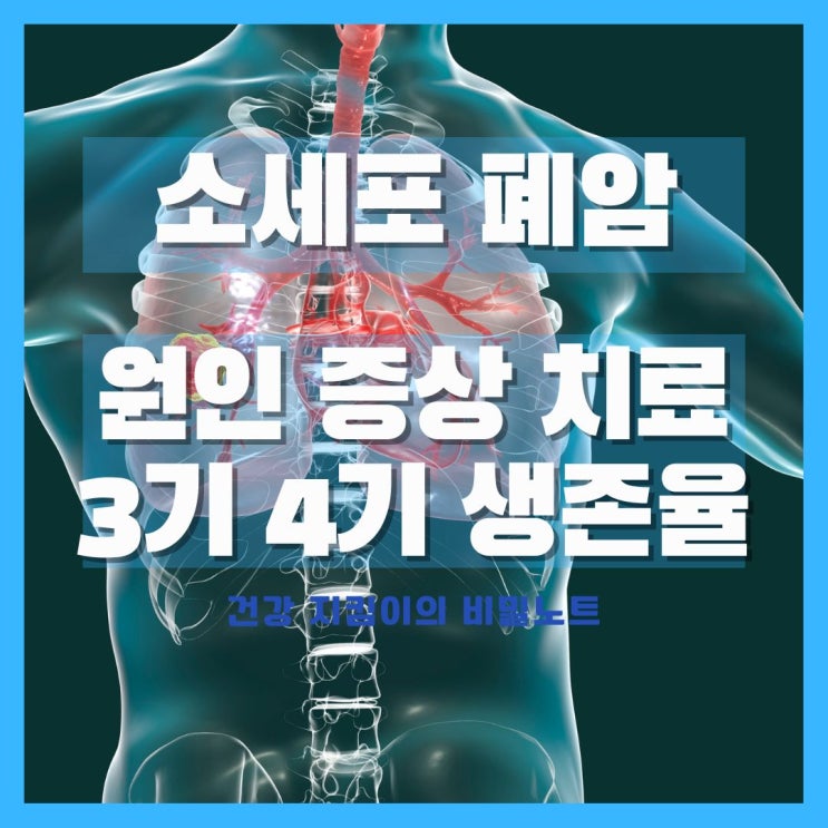  소세포 폐암 원인 증상 치료 3기 4기 생존율