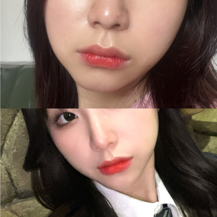  토르리프팅 RF + 소멸핏 지방분해주사 일주일 후기(효과/통증/가격)_청담 압구정로데오피부과