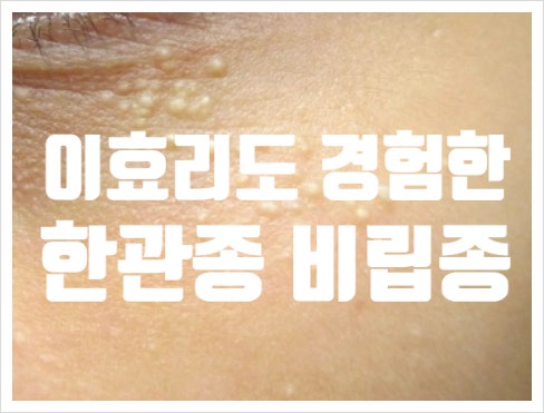 이효리도 경험한 피부질환 한관종과 비립종