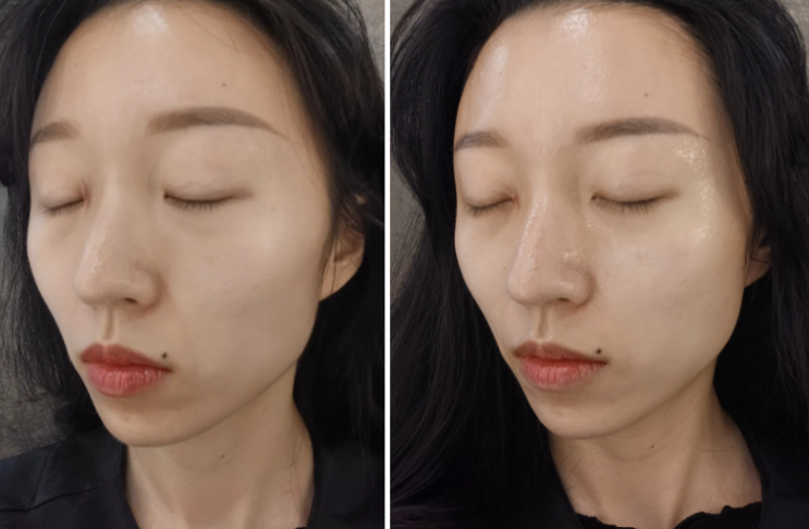  나만 알고싶은 수원 예민 피부 전문 | 세멘시트 리프팅 모공축소 관리