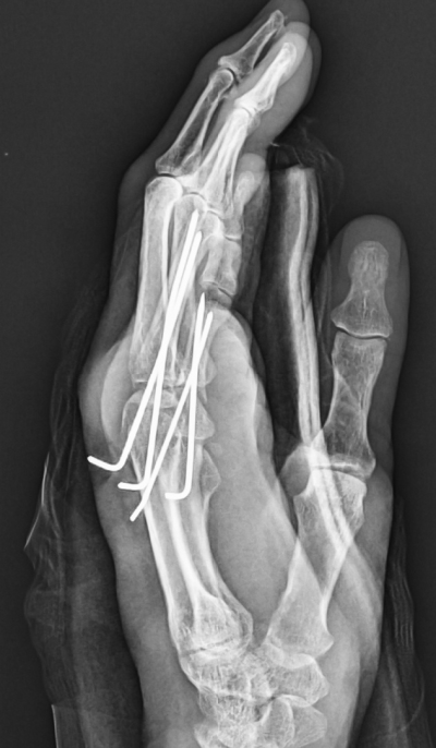 손가락 골절(Proximal phalanx Fracture)은 무조건 수술해야 하나요? 비수술 치료로 가능한 경우가 많습니다 ...