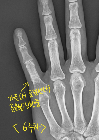 손가락 골절(Proximal phalanx Fracture)은 무조건 수술해야 하나요? 비수술 치료로 가능한 경우가 많습니다 ...