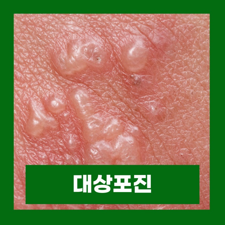  대상포진 초기증상 전염성 예방접종 치료법
