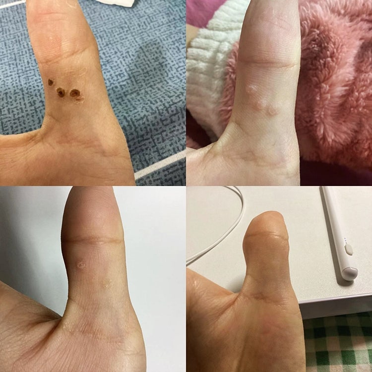 물사마귀 연고 손바닥 부위 제거 노하우