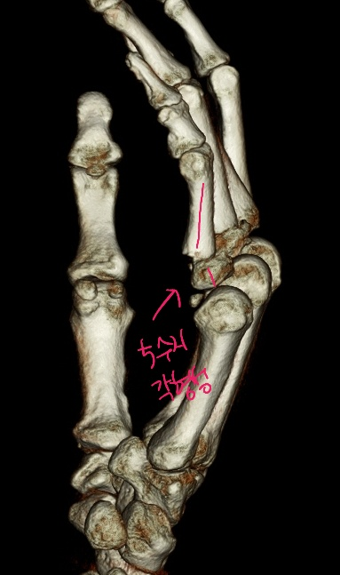 손가락 골절(Proximal phalanx Fracture)은 무조건 수술해야 하나요? 비수술 치료로 가능한 경우가 많습니다 ...