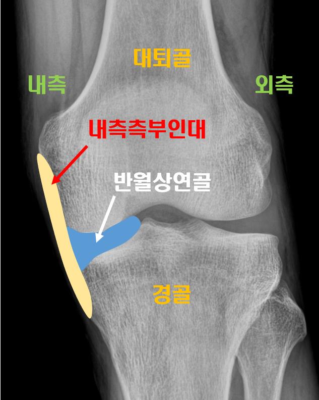  풍암동정형외과, 무릎 내측측부인대 파열 수술 필요할까요?