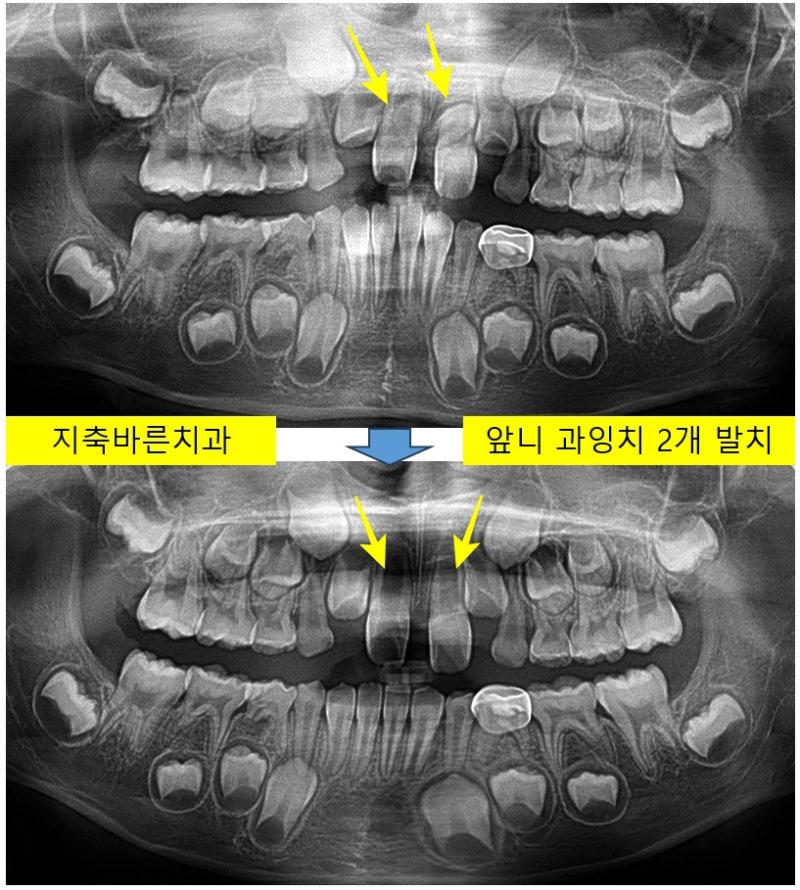 위쪽 앞니 사이 과잉치 발치 치료사례/ 성장기교정 소아교정 어린이교정 1차교정 교정 잘 하는 치과 3호선치과 삼송교정 지축교정 ...