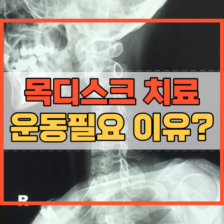 목디스크 치료방법 운동필요 이유 아시나요?
