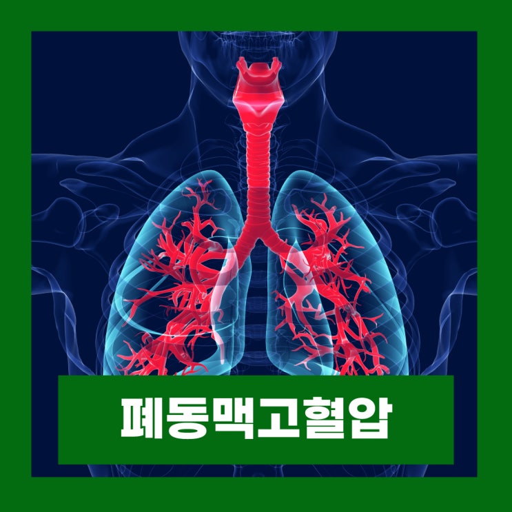 폐동맥고혈압 돌연사 원인 초기증상 검사 치료법