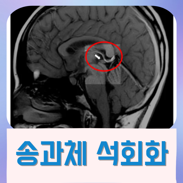  송과체 석회화 불소와의 관계 예방법