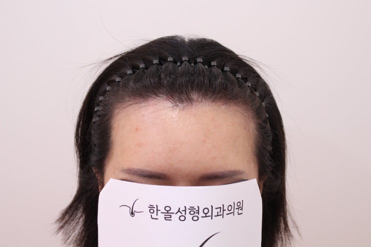 한올성형외과 첫 여성헤어라인 수술
