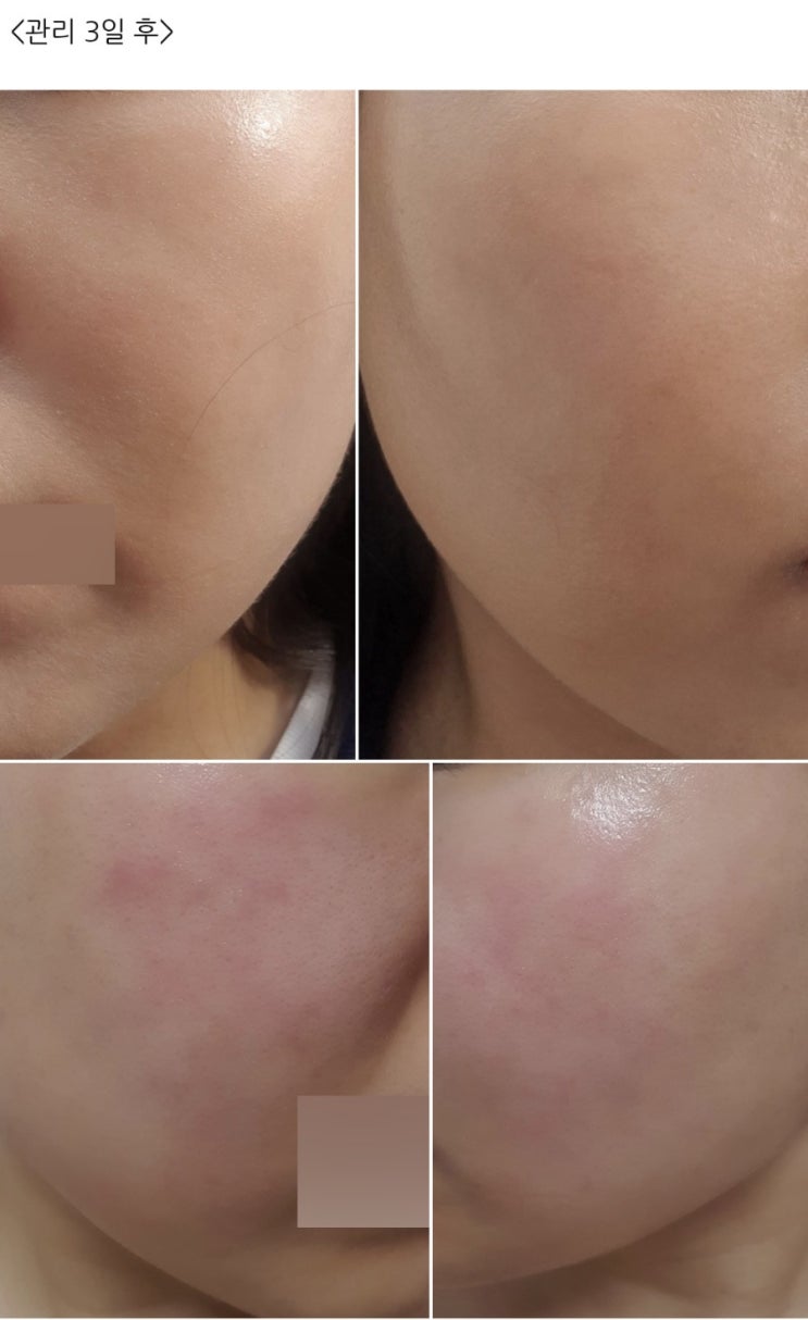  상암동 피부관리 아라에스테틱 약초필 트로이필 관리 후기