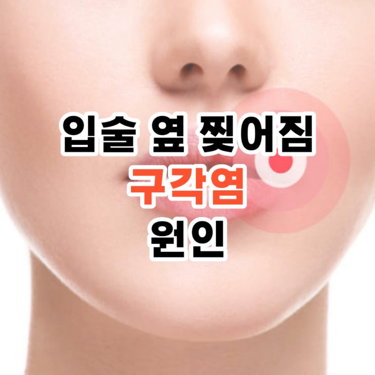 입술 옆 찢어짐 연고 구각염 원인