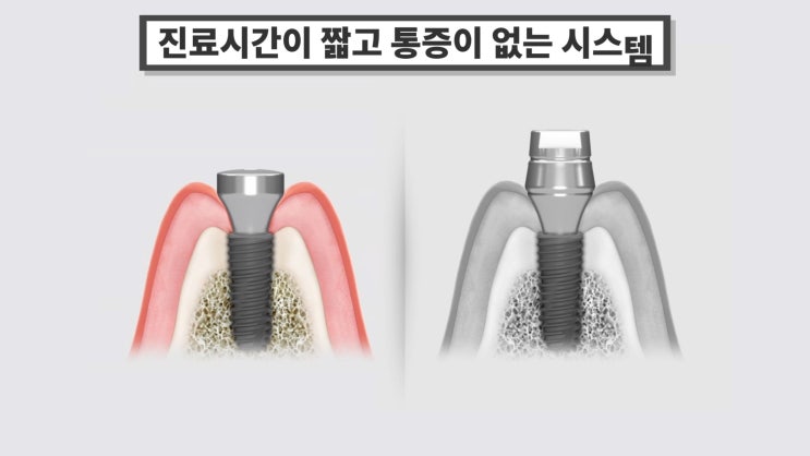  [탕정임플란트] 하이니스 디지털 보철 시스템을 도입합니다 / 천안 아산