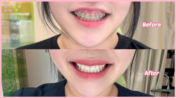  강남역 잇몸성형 | 치과 위생사도 하는 거미스마일 수술(치아 교정 중 구강전정술 리얼 후기, 부작용, 통증)