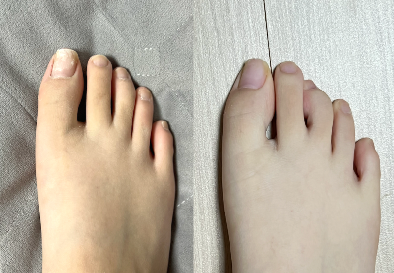 손발톱영양제 문제성 큐로힐 토네일