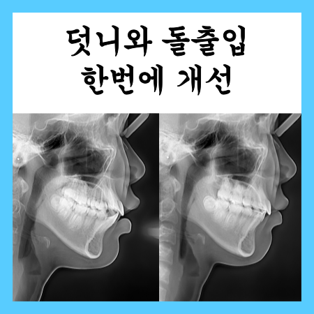  덧니와 돌출입 개선하고 싶어요, 교정 전후 비교