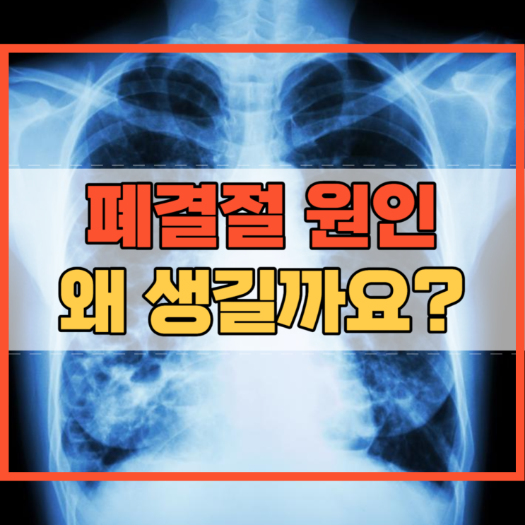  폐결절 원인 양성 암성 뭘까요?