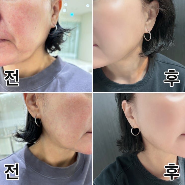  50대 리프팅 티타늄리프팅이 더해진 딥쎄라티 효과 2주차 후기
