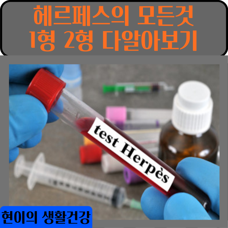  헤르페스 성병 치료 헤르페스2형원인 헤르페스 모든 증상 파악
