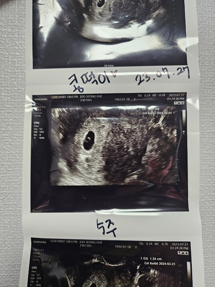  임신초기 피비침. 임신4주 5주 6주 피고임, 갈색혈 및 출혈 임신초기 중요정보
