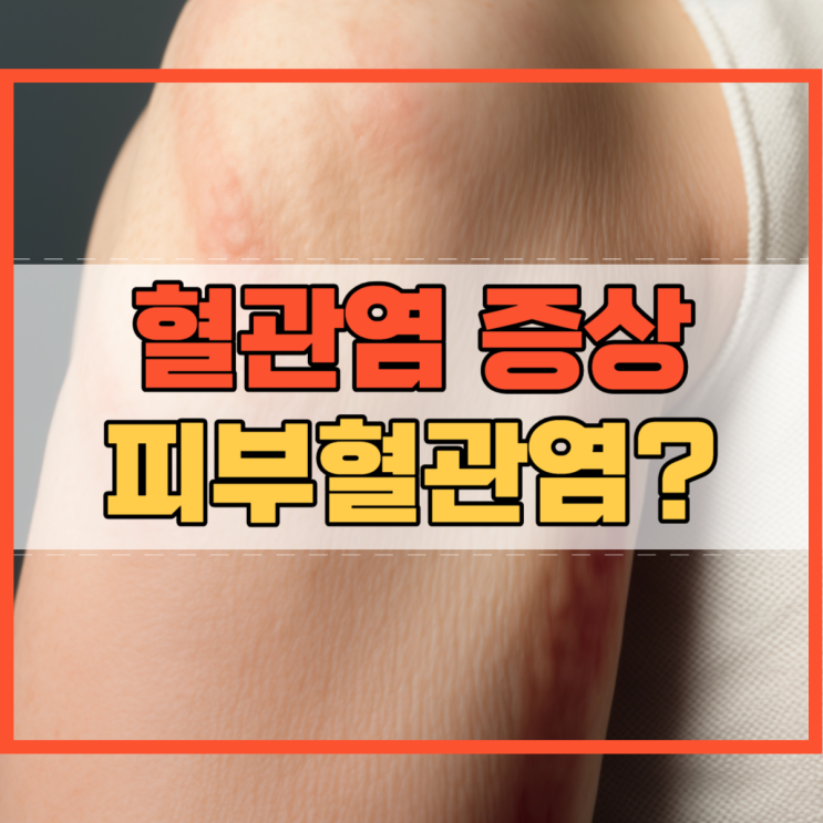  혈관염 증상 및 피부혈관염 피부정맥염 아시나요?