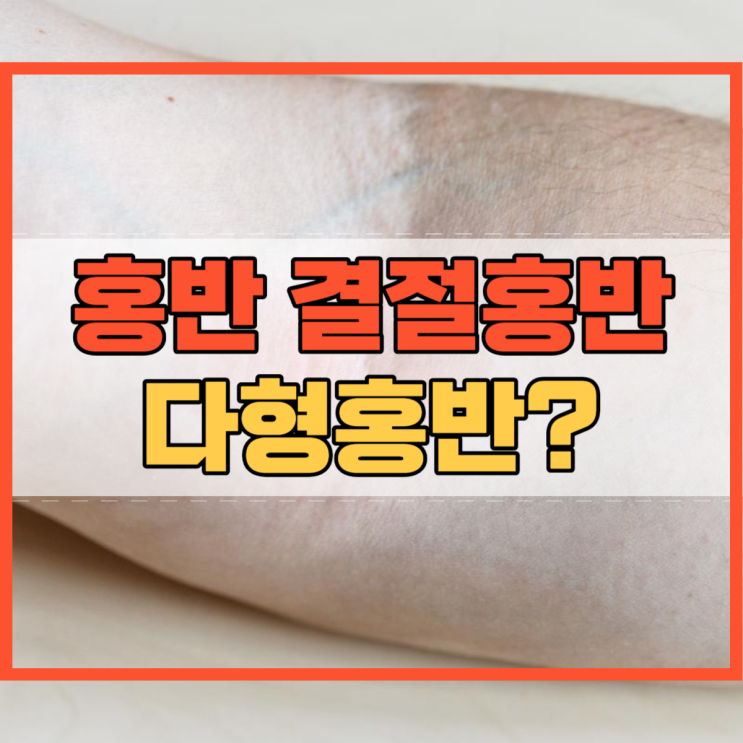  홍반 결절홍반 다형홍반 증상 및 원인 치료 방법과 다른 점!