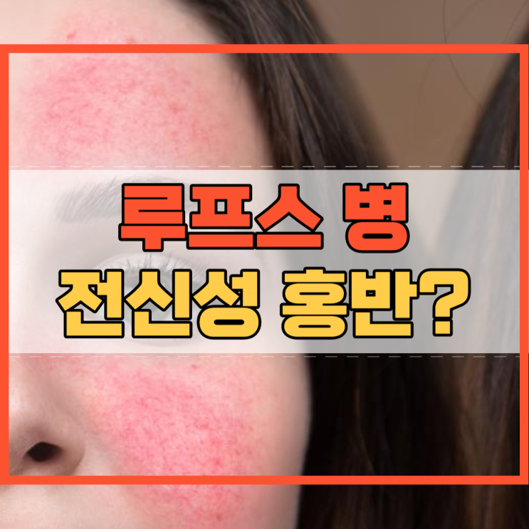  루푸스 및 전신성 홍반루푸스 루푸스병 원인 증상!