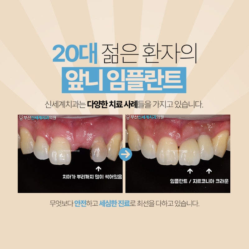 부산앞니임플란트에 대해서 5