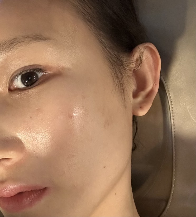  언주 피부관리 썸에스테틱 이어테라피 받아본 후기