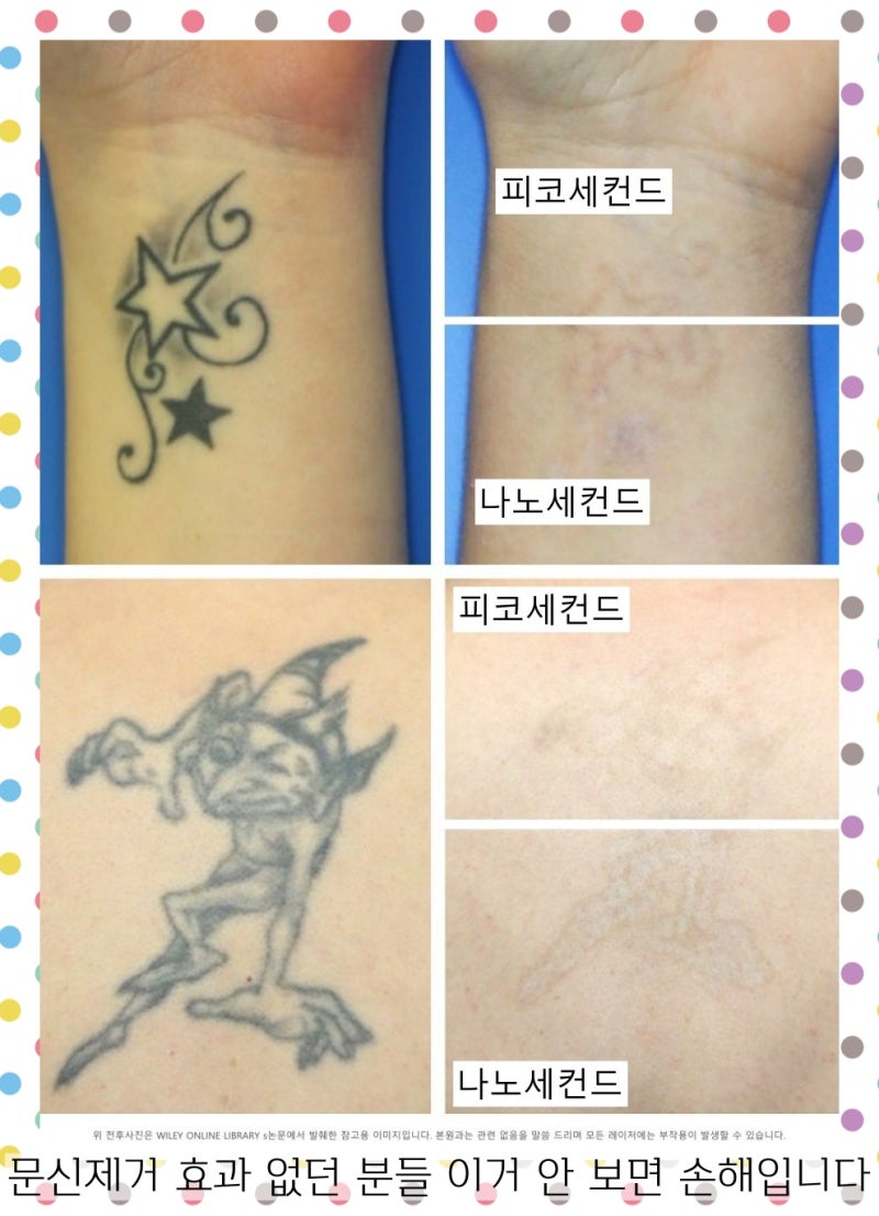 청주 문신제거 노하우 모두 알려드립니다